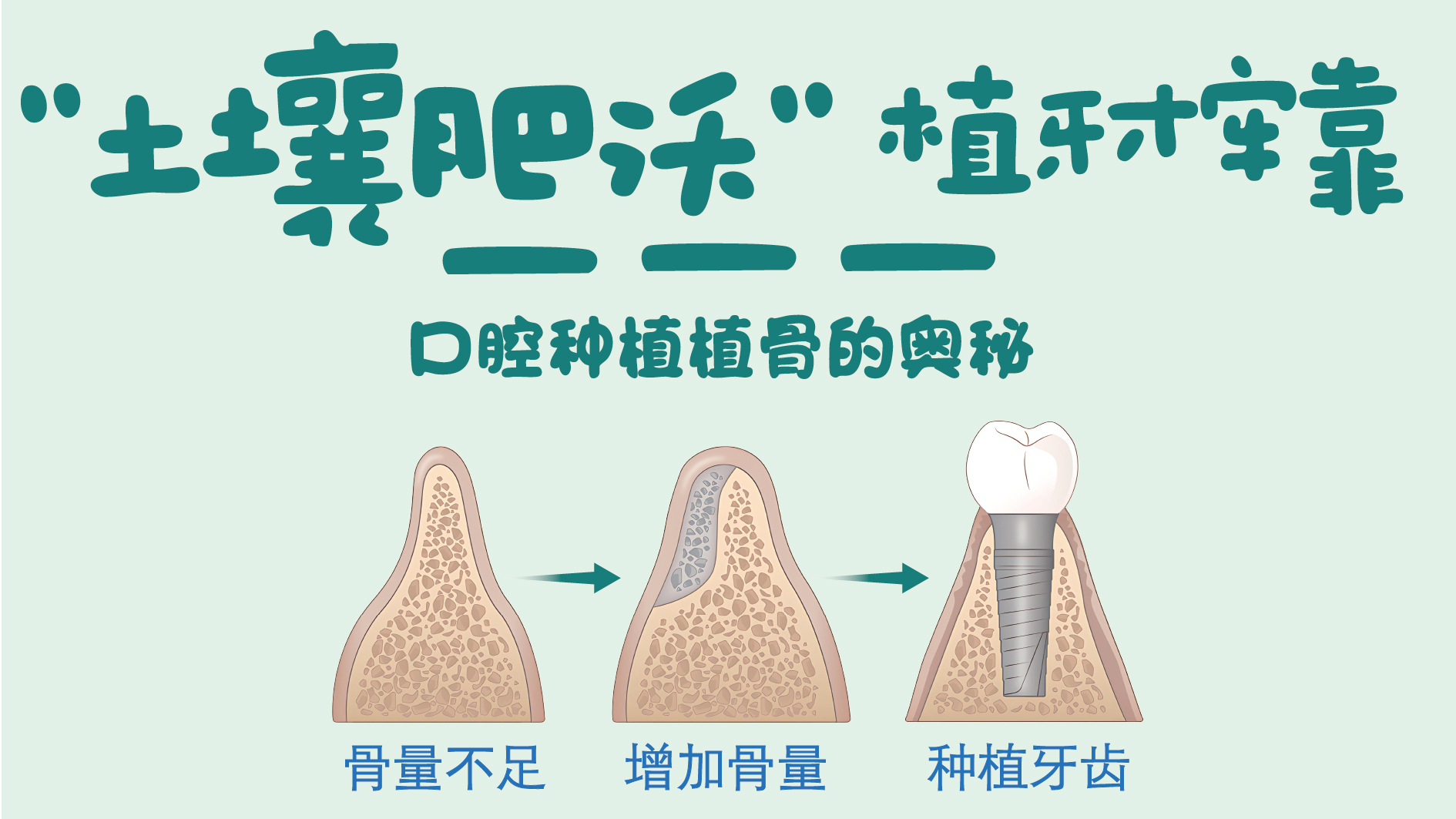 “土壤肥沃”植牙才牢靠——口腔种植植骨的奥秘