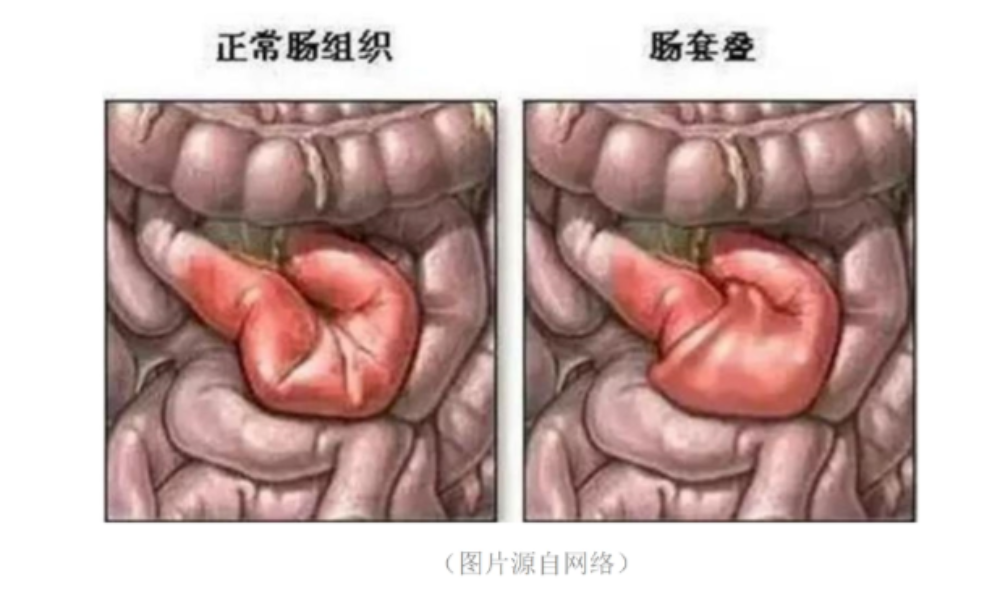 肠套叠——当宝宝的肠子玩起“大肠套小肠”